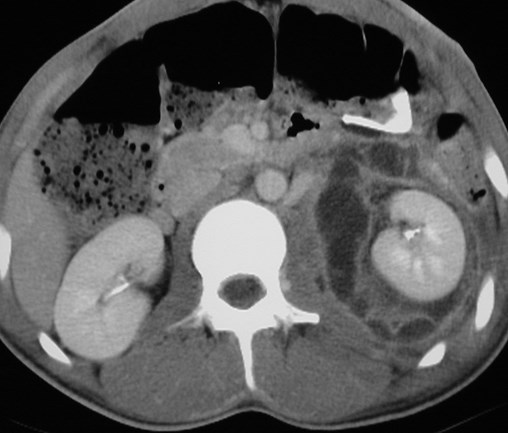 Pancreatic trauma with perinephric pseudocyst-CT